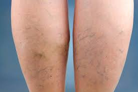 Varicose Veins