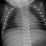 Chest-radiograph-showing-clear-l