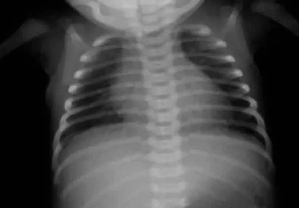 Chest-radiograph-showing-clear-l