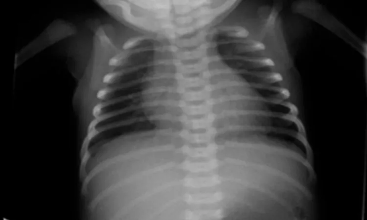 Chest-radiograph-showing-clear-l