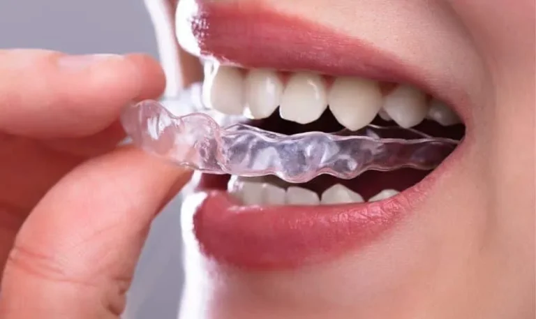 Invisalign-Teen-in-Lenexa