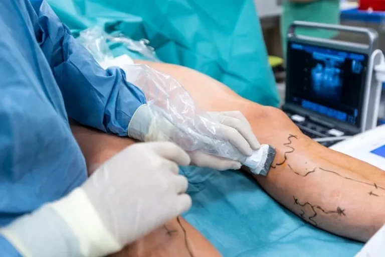 Varicose-Veins-Laser-Treatment