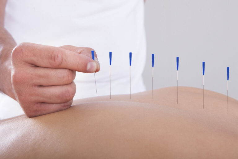 acupuncture-pain-relief-complementary