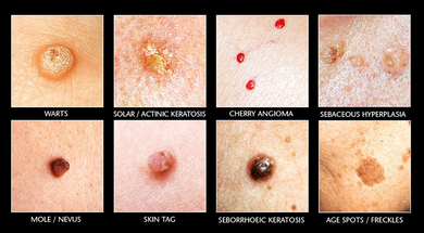 Types of Skin Growths